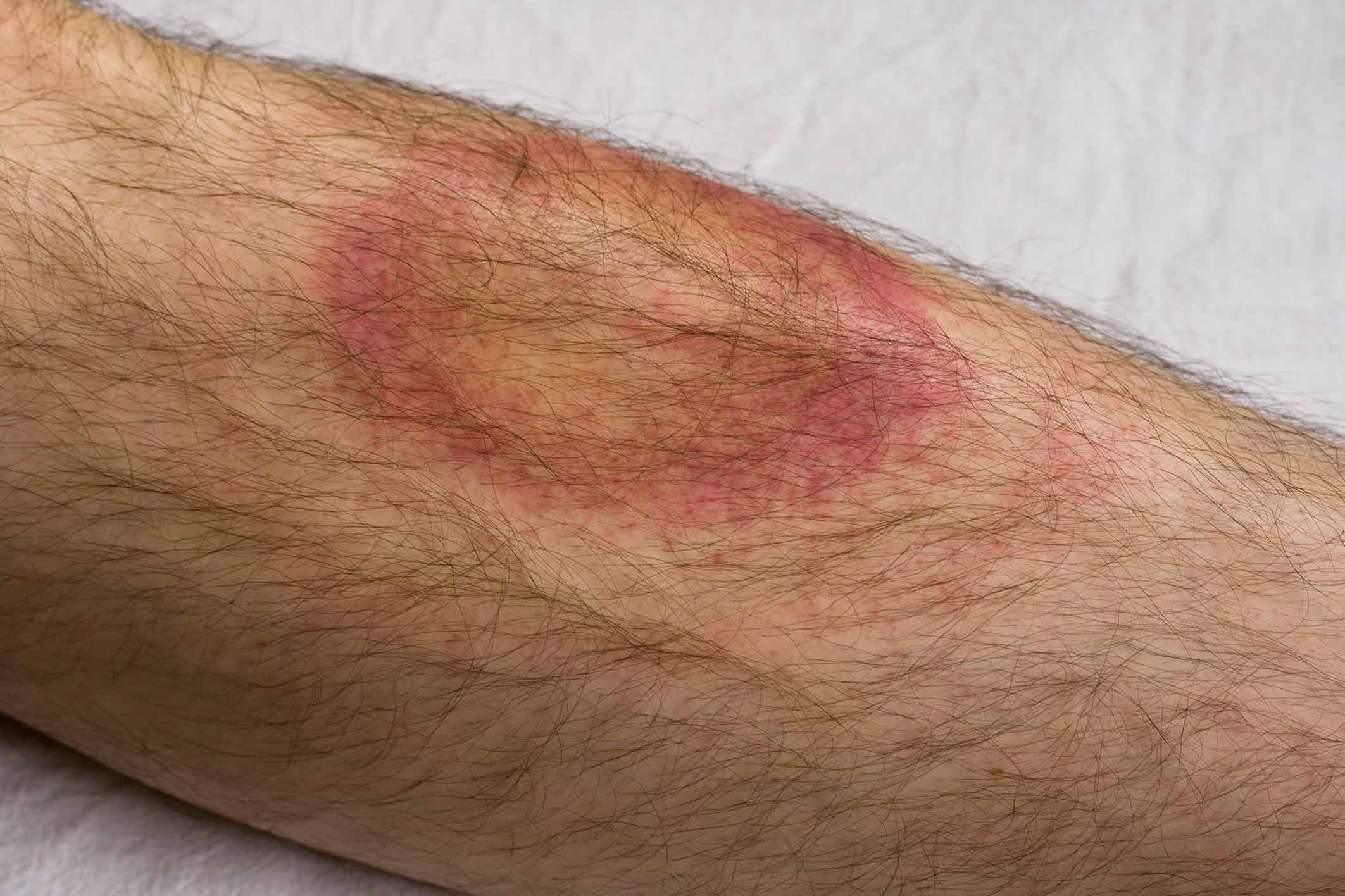 Lyme Disease Pain Symptoms and Treatments PainScale