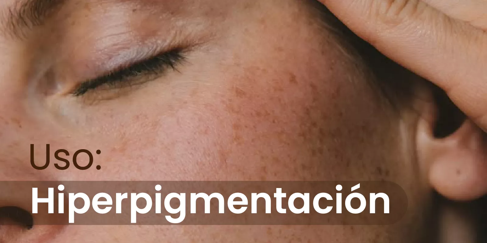 Uso: Hiperpigmentación (manchas en la piel)