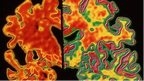 Alzheimer's disease