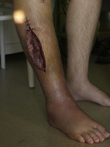 Fasciotomy_leg