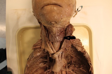 Thyroidcad