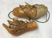 Arm and Detachable Wrist Prosthesis