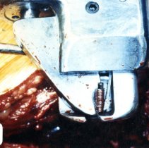 Back surgery cutting tool during surgery