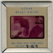 Slide No. 151 Benign Tumors