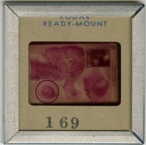 Slide No. 169 Benign Tumors - Multiple Polyposis