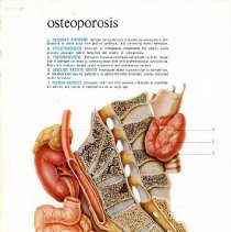 Osteoporosis
