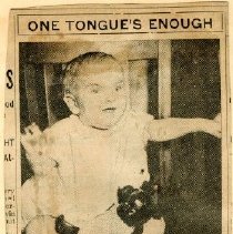 Girl is Born With Two Tongues Surgeons Cut On of Them Out