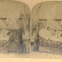 Stereograph of a young girl lying in bed with angels above