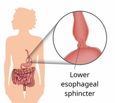 Body outline showing the stomach, esophagus, and intestines, with a close-up of a tight lower esophageal sphincter.