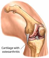 A knee joint, showing the effects of osteoarthritis on the cartilage. 