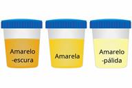 A comparison of three sample cups showing dark yellow, yellow, and pale yellow urine.