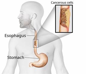 Upper body outline showing the esophagus and stomach, with a close-up of cancer cells in the esophagus.