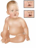 A baby with a cleft lip with close-ups showing the types of cleft lip.