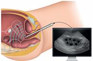 A thin wand-like device inserted into a vagina and an inset of a computer screen displaying an ultrasound image.