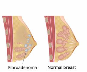 Side view of a normal breast compared to a side view of a breast with fibroadenoma.