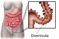 Body outline showing the stomach and intestines, with a close-up of diverticula on the large intestine.
