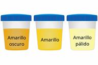 A comparison of three sample cups showing dark yellow, yellow, and pale yellow urine.