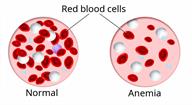 Comparison of blood with a normal amount of red blood cells to blood with fewer red blood cells when a person has anemia.