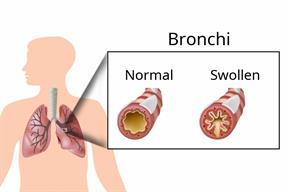 A comparison between normal and swollen airways, or bronchi, in the lungs.