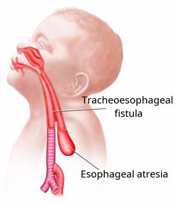 A baby's head and upper body, showing a TE fistula and esophageal atresia. 