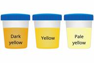 A comparison of three sample cups showing dark yellow, yellow, and pale yellow urine.