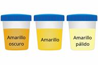 A comparison of three sample cups showing dark yellow, yellow, and pale yellow urine.