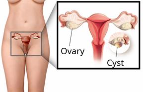 The female reproductive system, with a close-up of the ovaries and an ovarian cyst.
