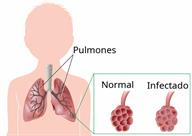 An outline of a child with a view of the lungs and a close-up of part of a lung that is normal, and the same part infected.