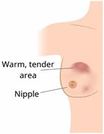 Front view of a breast showing a tender area of inflammation.
