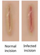 Two incisions closed with skin glue. One is normal. The other is red with pus and infected.