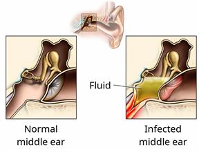 An ear, with close-ups of a normal ear and an ear filled with fluid.