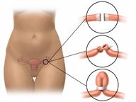 Three ways of blocking fallopian tubes. The tubes may be cut and burned, or cut and tied, or blocked with a clip.
