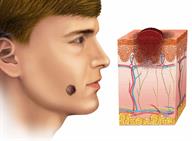 Skin cancer on a person's face, with a close-up view of the cancer growing in the skin layers.