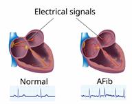 A heart with normal electrical activity and a heart with abnormal electrical activity.