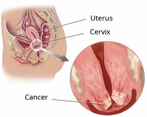 Side view of a body area showing the uterus and cervix, with a close-up of cervical cancer.
