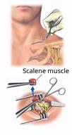 An incision being made above a person's clavicle, with a close-up showing cutting and removal of the scalene muscle.