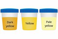 A comparison of three sample cups showing dark yellow, yellow, and pale yellow urine.