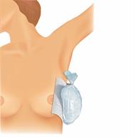A person with a cold compress on the side of the breast.