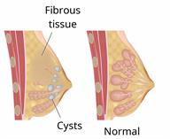 Side view of a normal breast compared to a side view of a breast with some fibrous tissue and cysts.