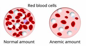 Comparison of blood with a normal amount of red blood cells to blood with fewer red blood cells when a person has anemia. 