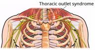 Thoracic outlet syndrome in the shoulder area. There is redness where nerves between the collarbone and neck are squeezed.