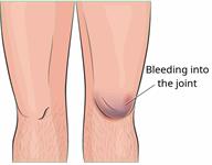 A person's legs, showing a normal knee and a knee with bleeding into the joint.