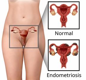 The female reproductive system, with a close-up showing a normal uterus and a uterus with endometriosis.