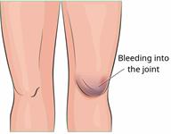 A child's legs, showing a normal knee and a knee with bleeding into the joint.