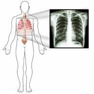An outline of a person's body and an image of an X-ray of the person's chest. 