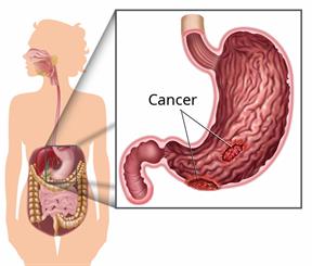 Body outline showing digestive organs with a close-up of cancer inside the stomach.