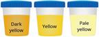 Three cups showing dark yellow, yellow, and pale yellow urine.