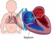 Body outline showing the heart inside an infant's chest with a close-up view of an atrial septal defect in the heart. 