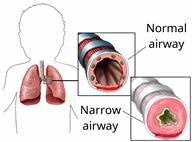 Outline of a person's upper body showing the lungs, with close-ups of two airways, one normal and one narrow.