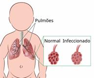An outline of a baby with a view of the lungs and a close-up of part of a lung that is normal, and the same part infected.